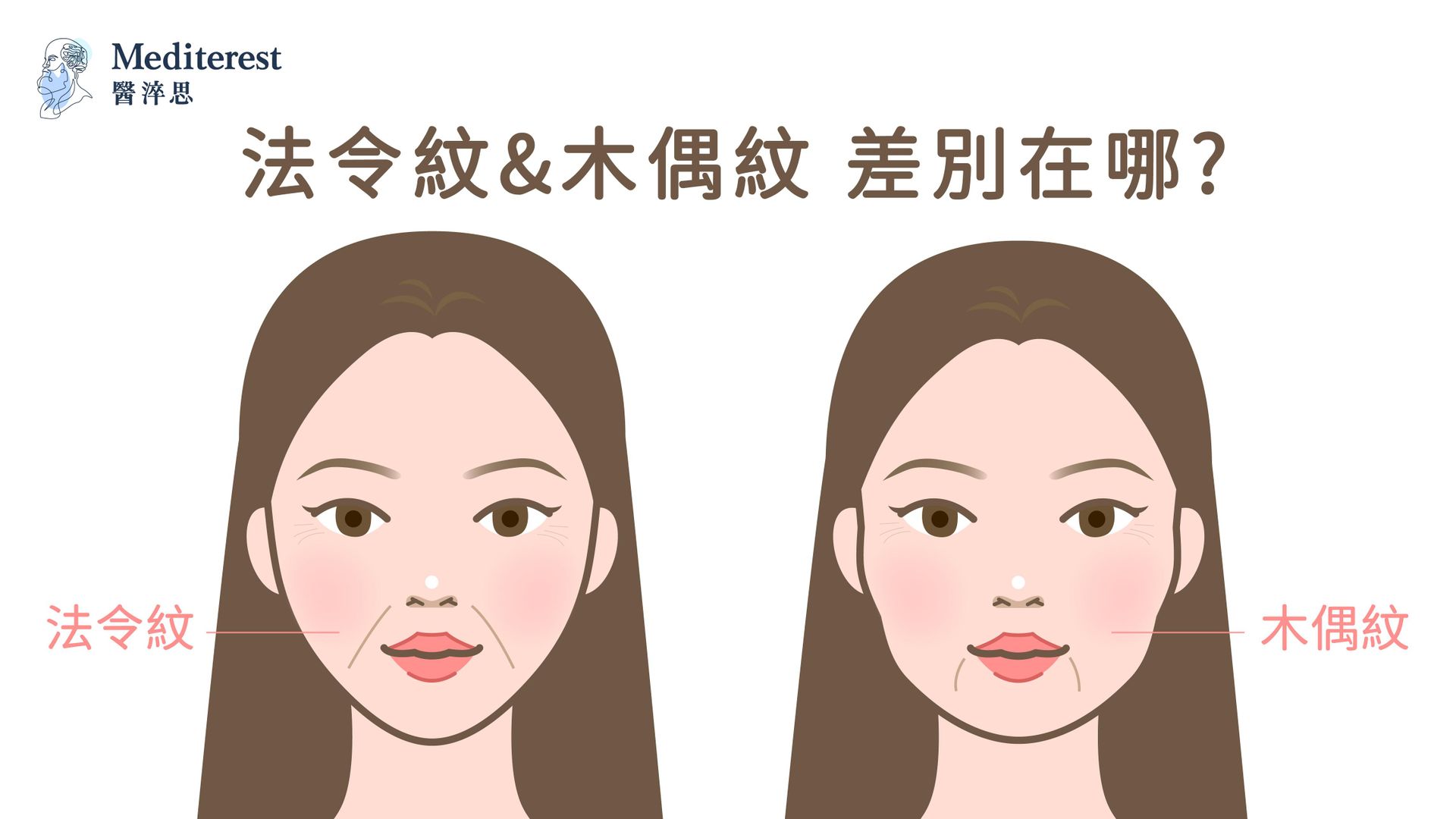 法令紋和木偶紋的差別