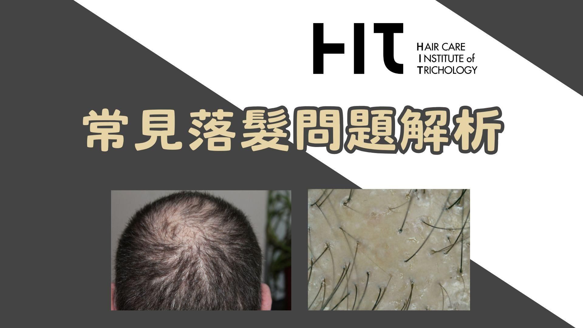 常見落髮問題解析