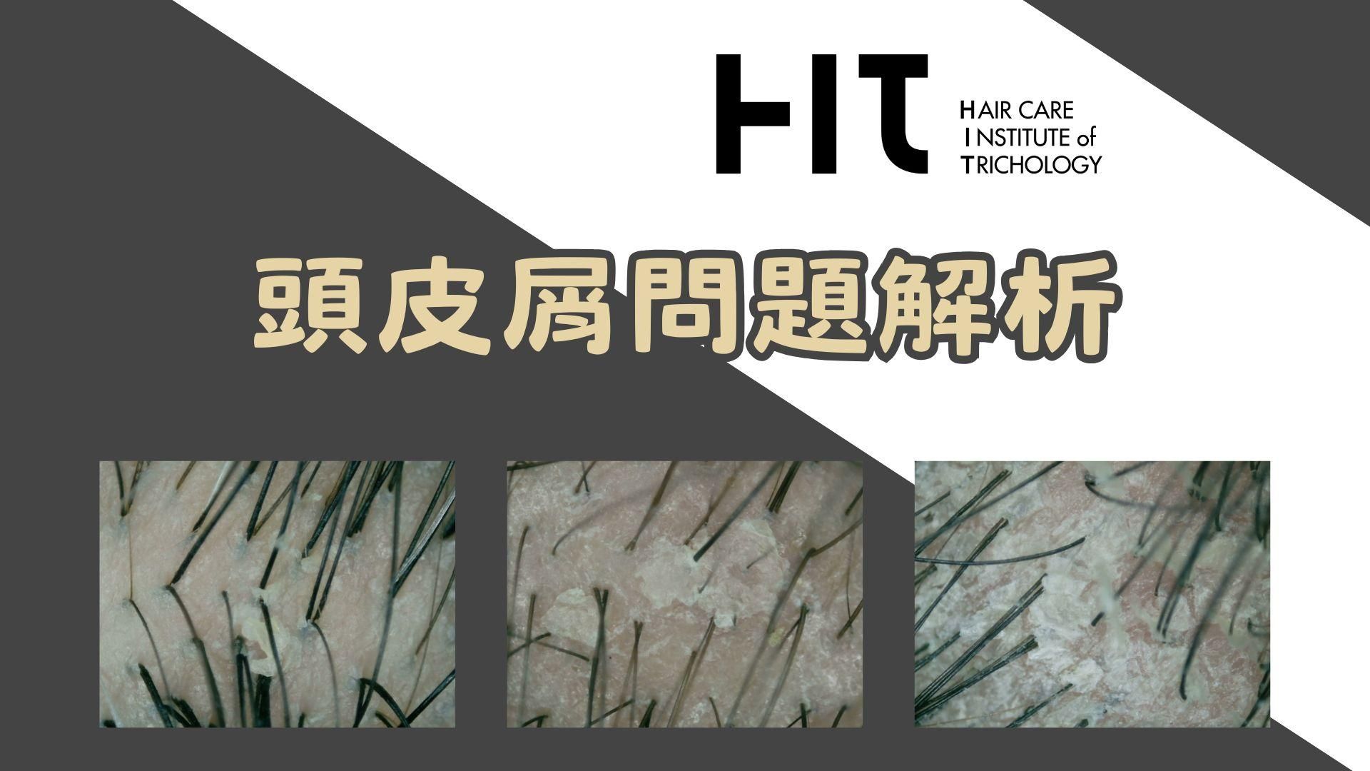 頭皮屑問題解析